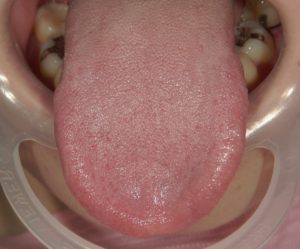 舌の表面が真っ白 これってなぁに 松山市 丸尾歯科